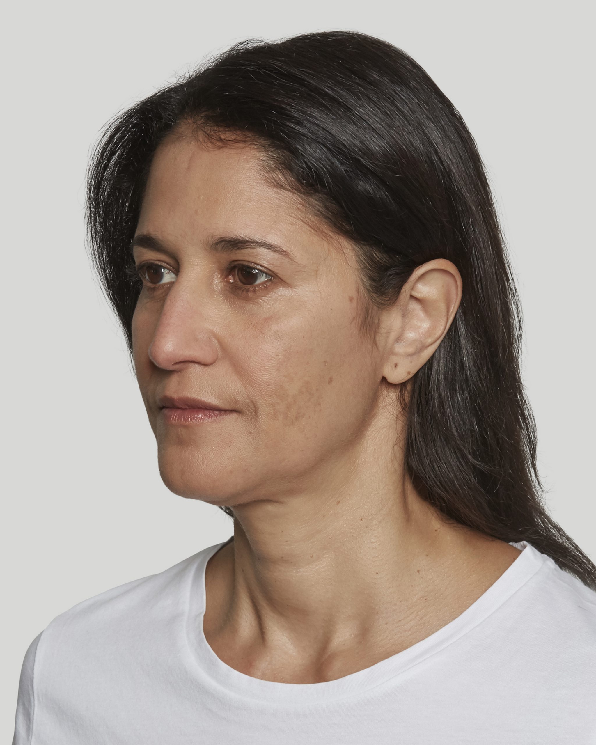 Sculptra Sacramento Calkin and Boudreaux