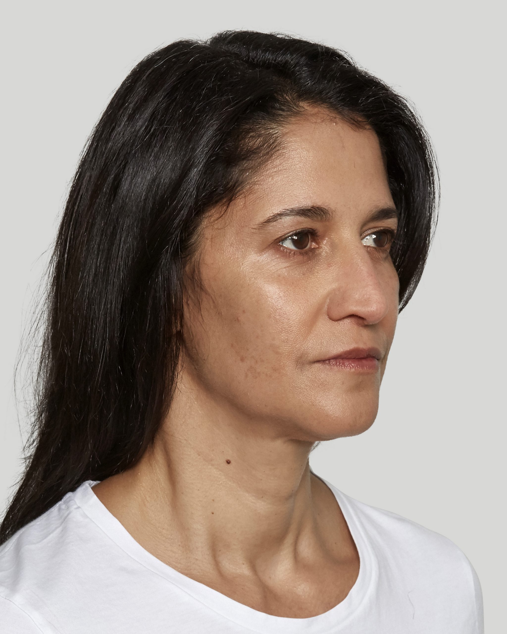 Sculptra Sacramento Calkin and Boudreaux