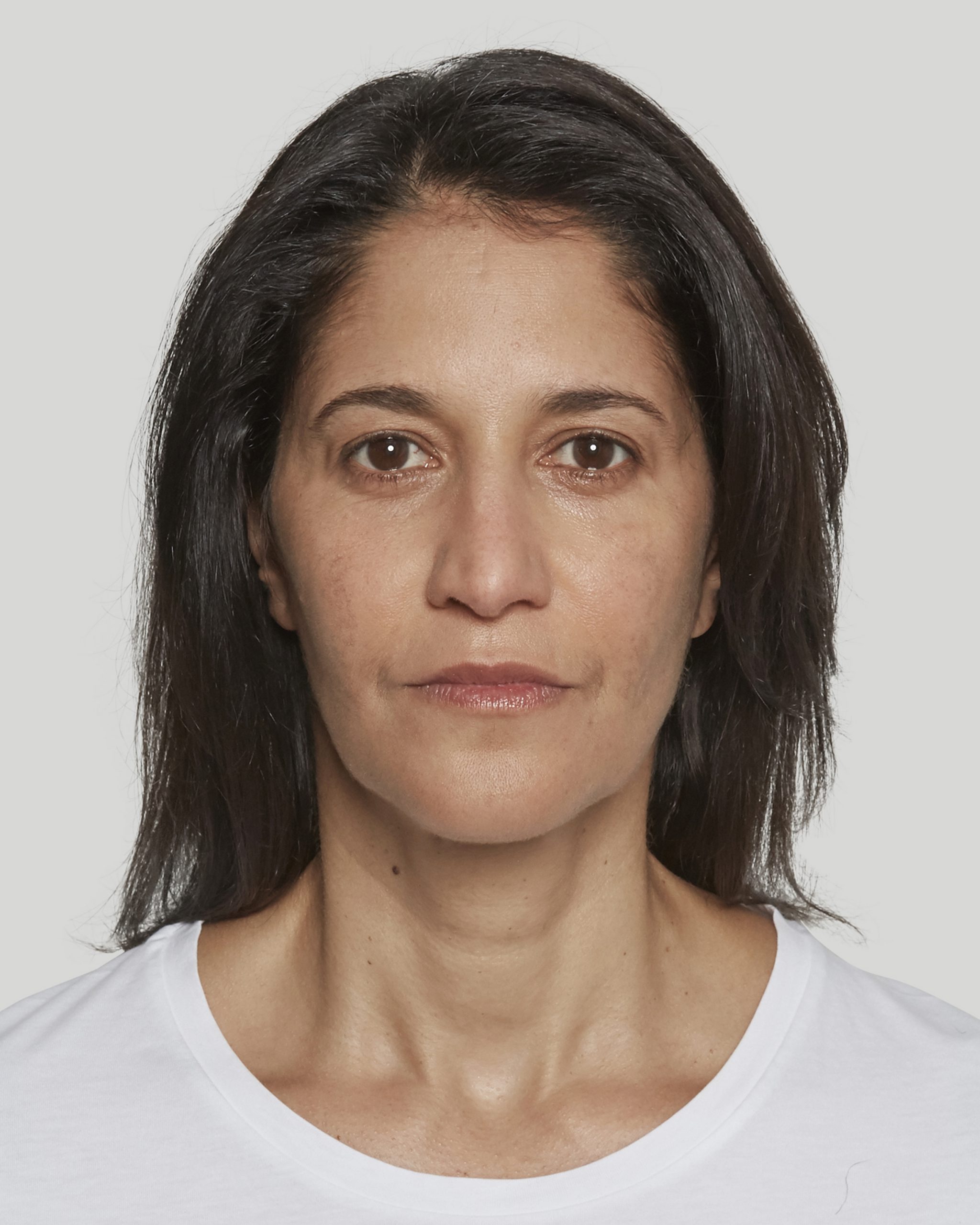 Sculptra Sacramento Calkin and Boudreaux