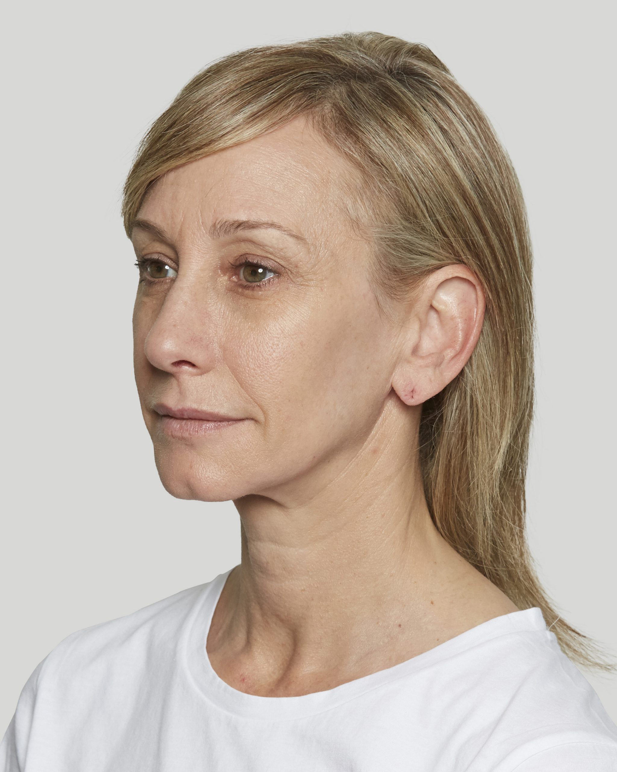 Sculptra Sacramento Calkin and Boudreaux