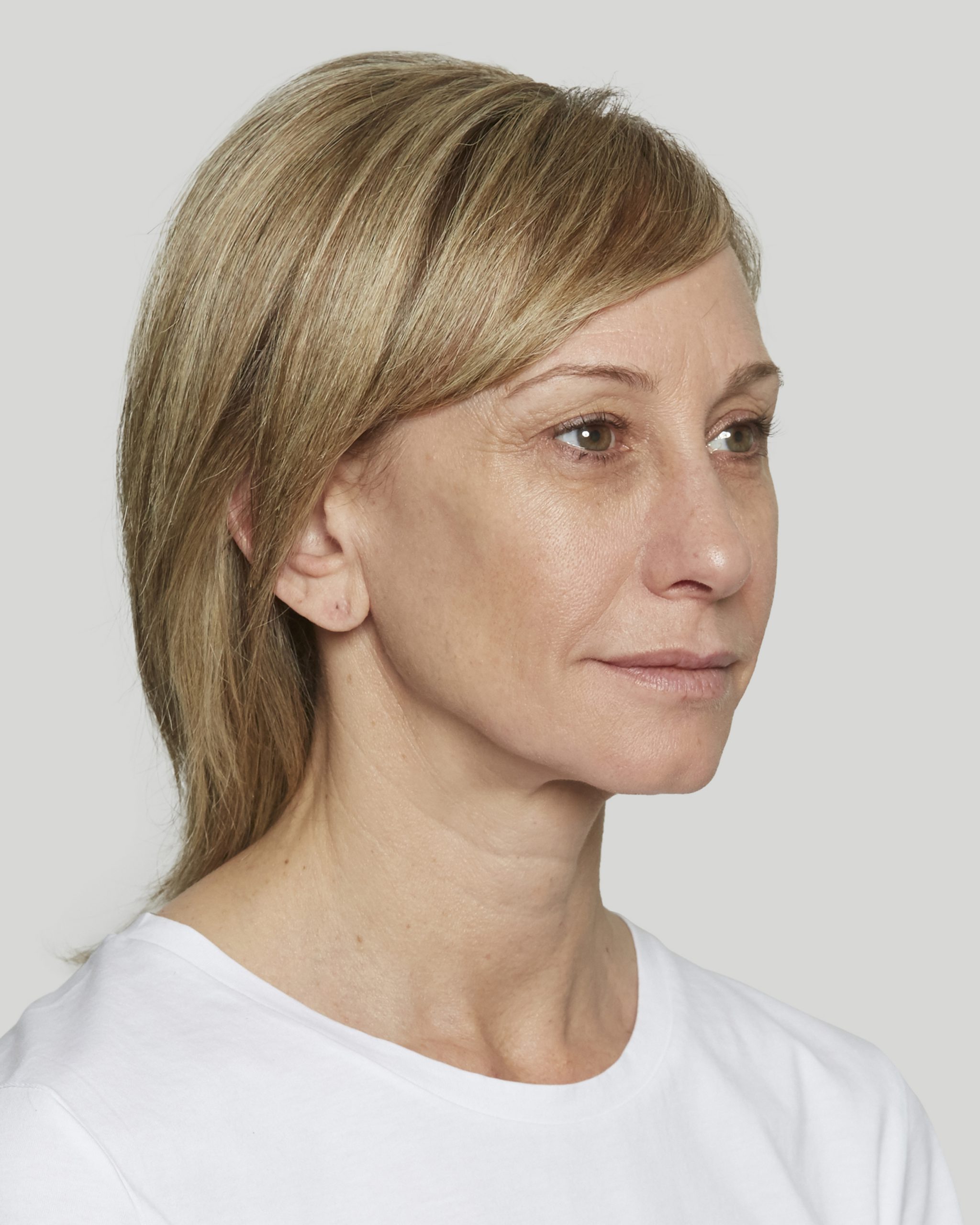 Sculptra Sacramento Calkin and Boudreaux