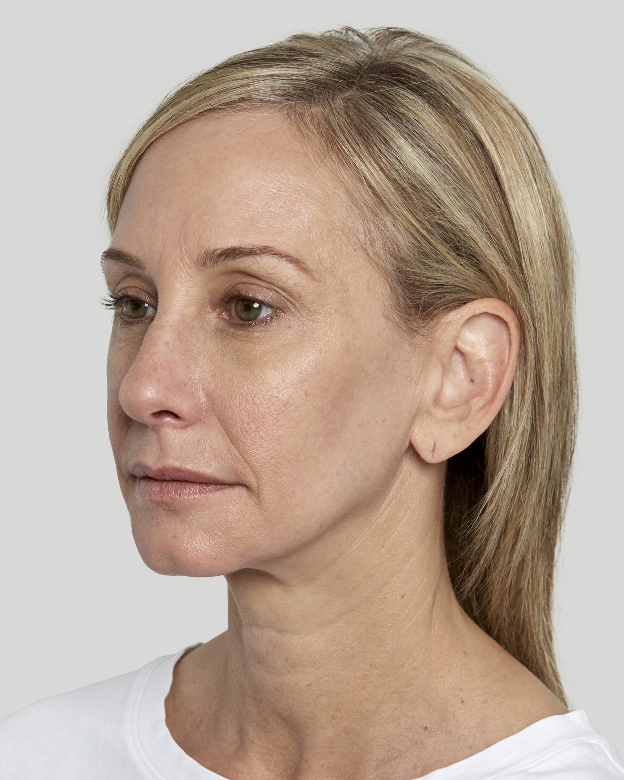 Sculptra Sacramento Calkin and Boudreaux