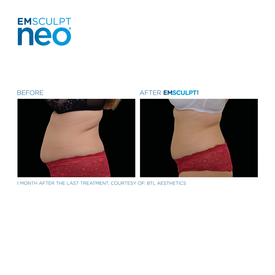 EMSCULPT NEO - Calkin & Boudreaux Dermatology Associates