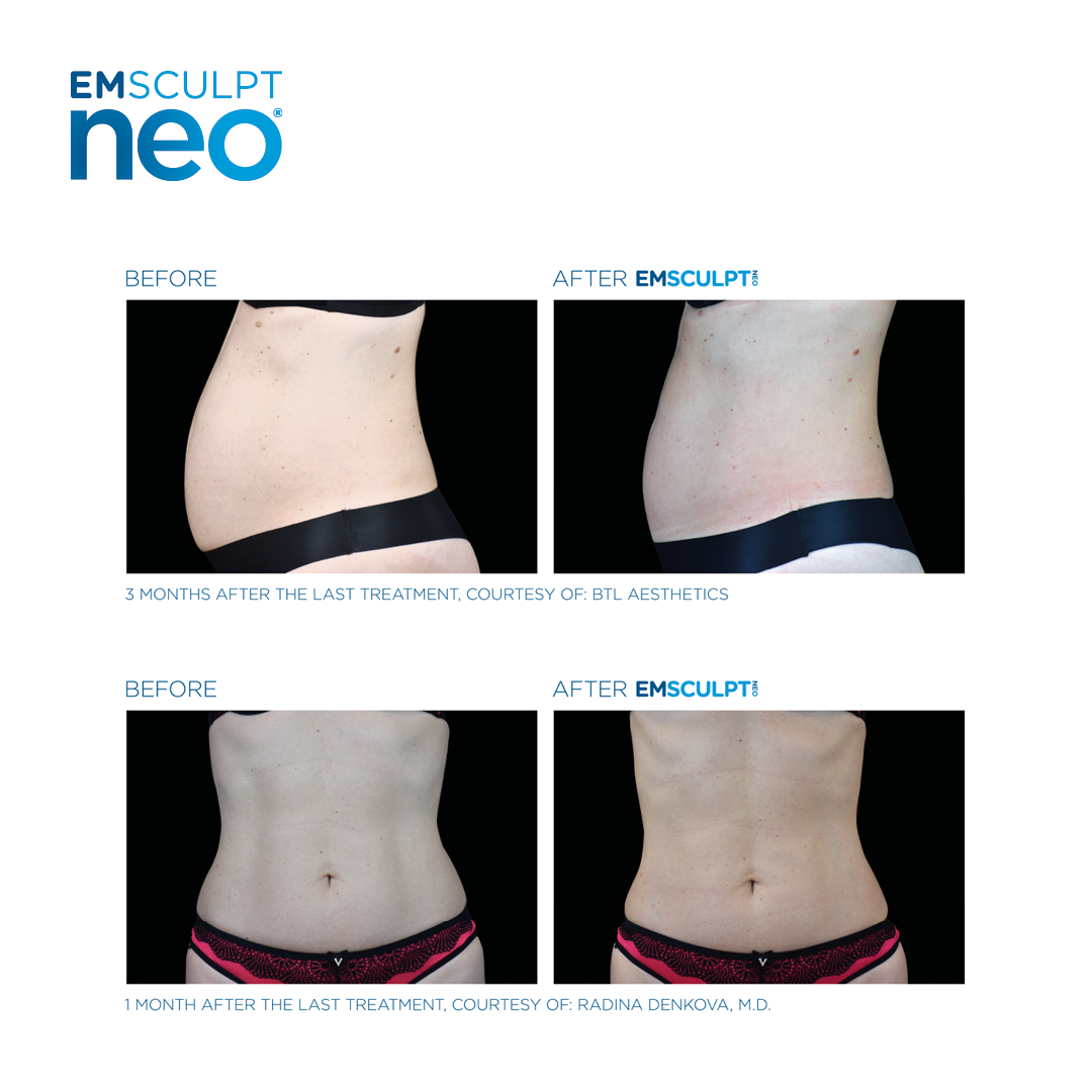 BTL Emsculpt Neo