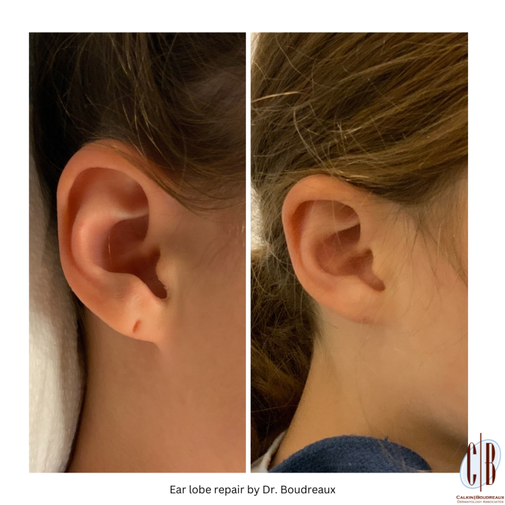 Earlobe Repair Surgery in Orlando